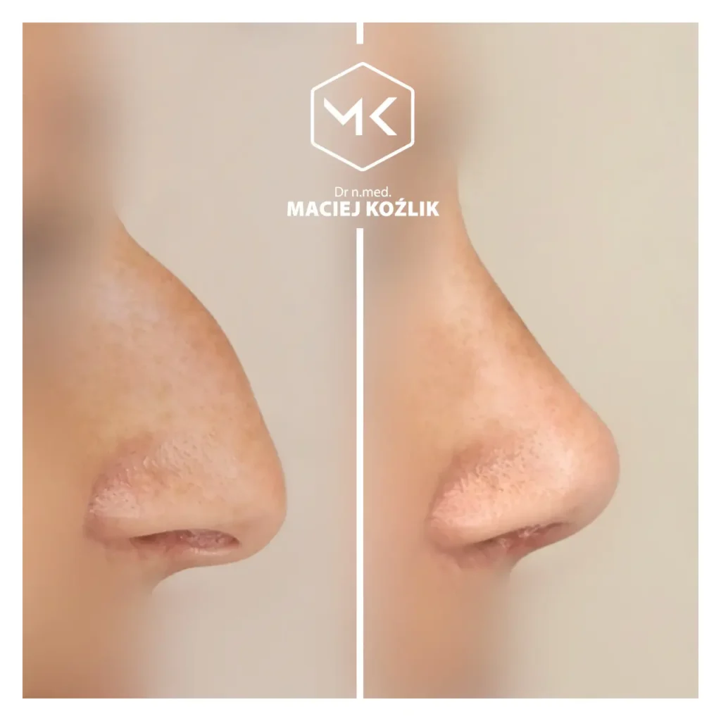 Plastyka nosa Wrocław - Dr Maciej Koźlik - chirurgia plastyczna nosa