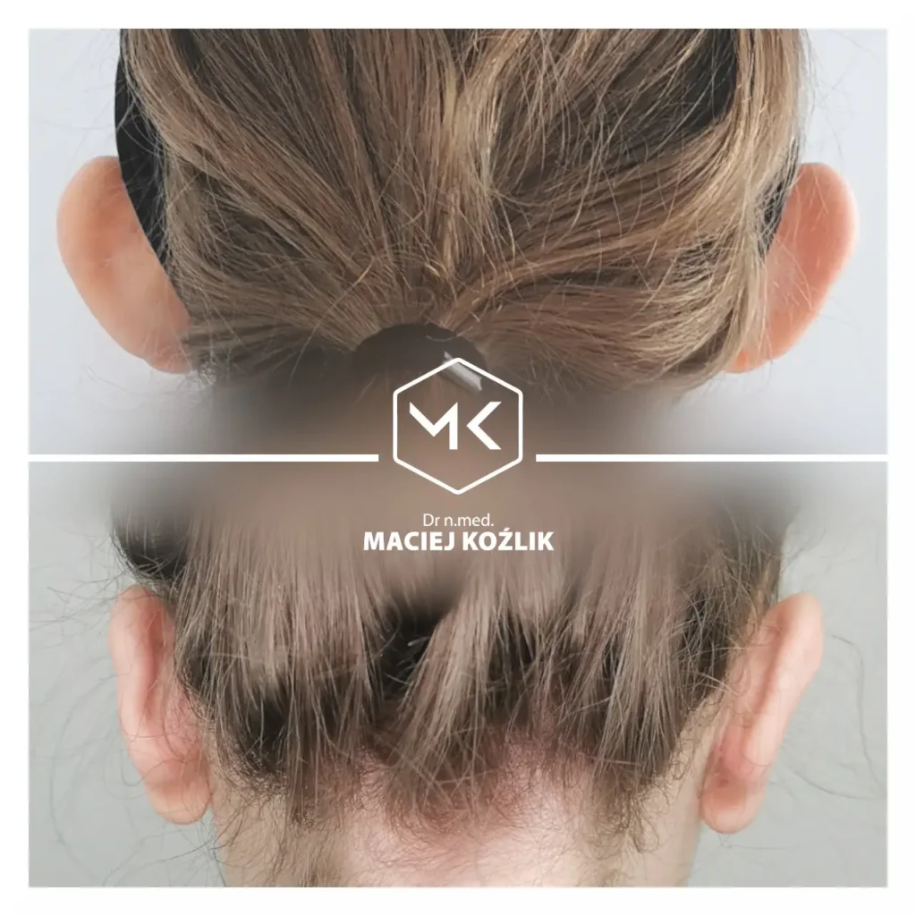 Plastyka uszu Wrocław - Dr Maciej Koźlik - korekcja odstających uszu